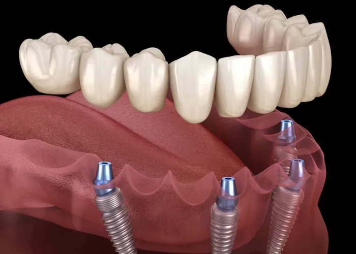 Dr.-sana-dental-implants