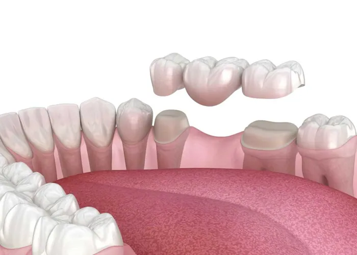 Dr.-sana-drntal-crowns