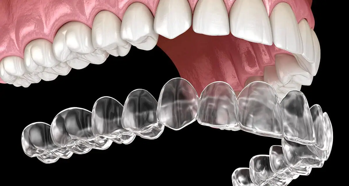 aligner
