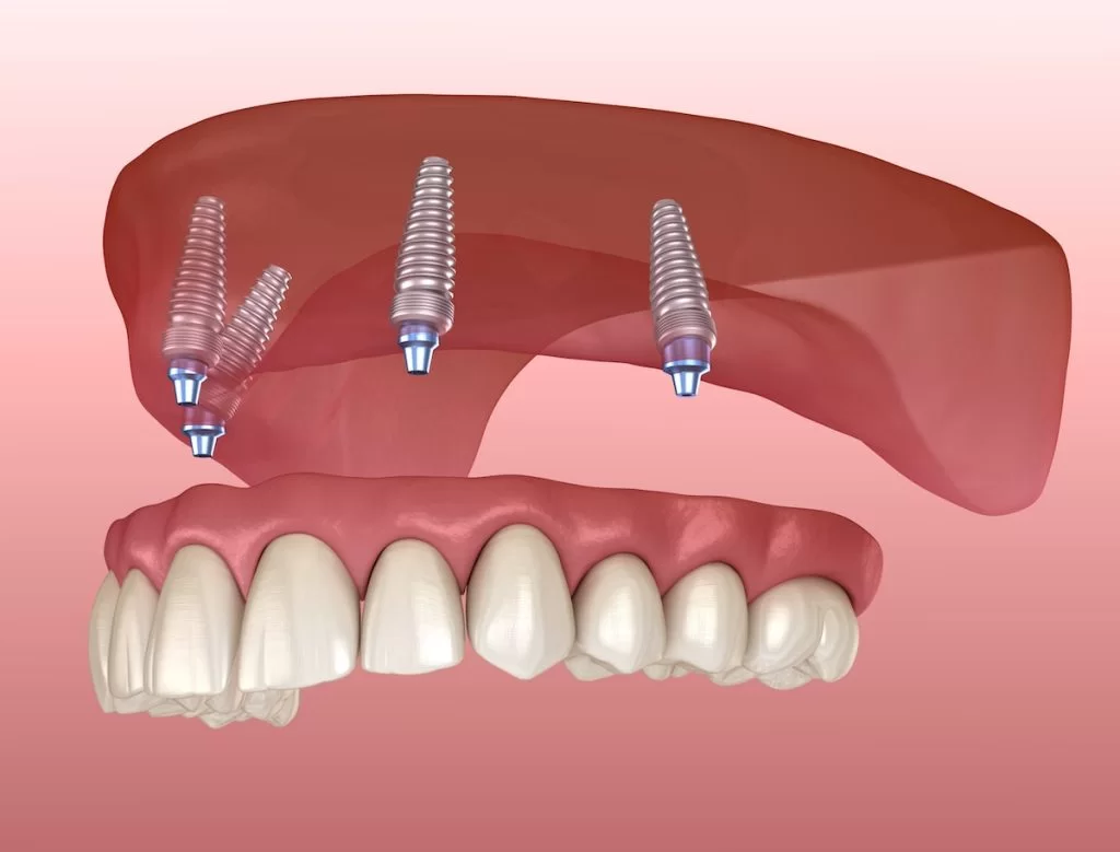 all-on-4-dental-implants-1024x779
