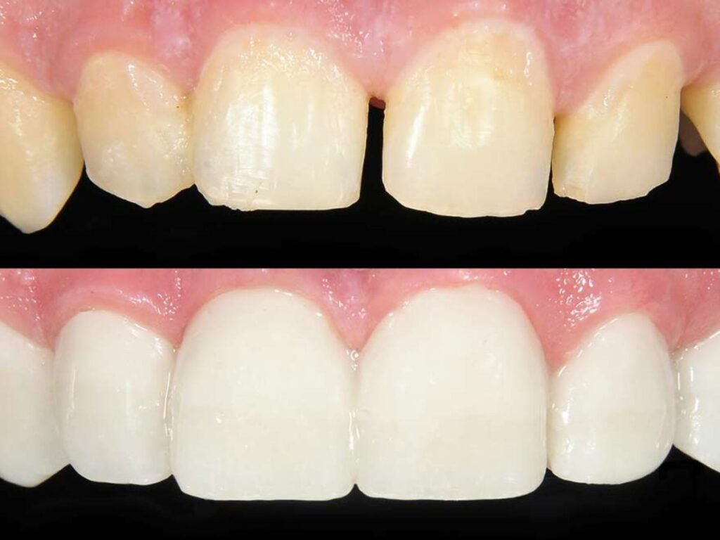 Cosmetic dental bonding-shubham dental clinic Hisar