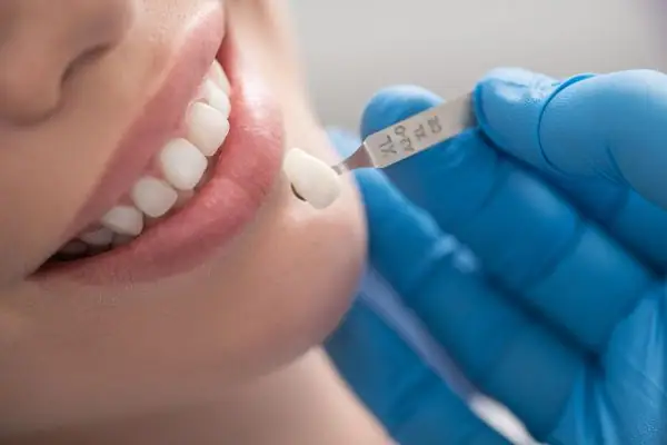 dental-veneer