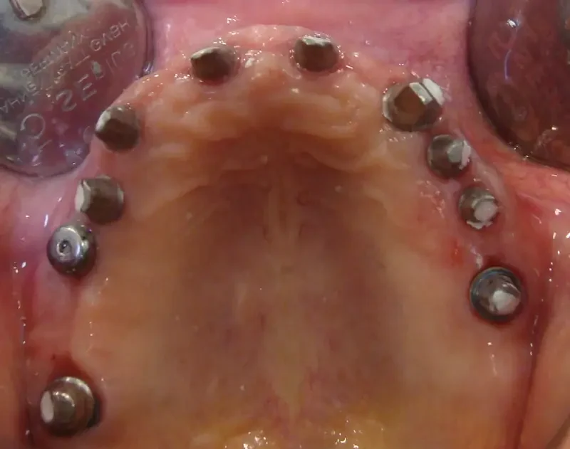 full-mouth-rehabilitation-using-implants-img1