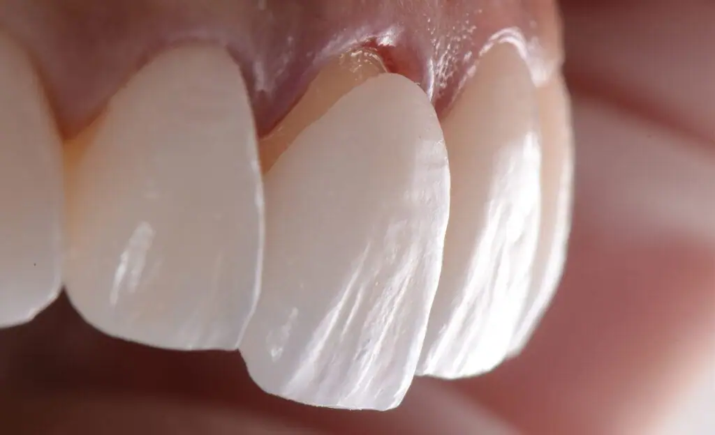 laminate-veneers-best-dentist-kusadasi-2-1024x624