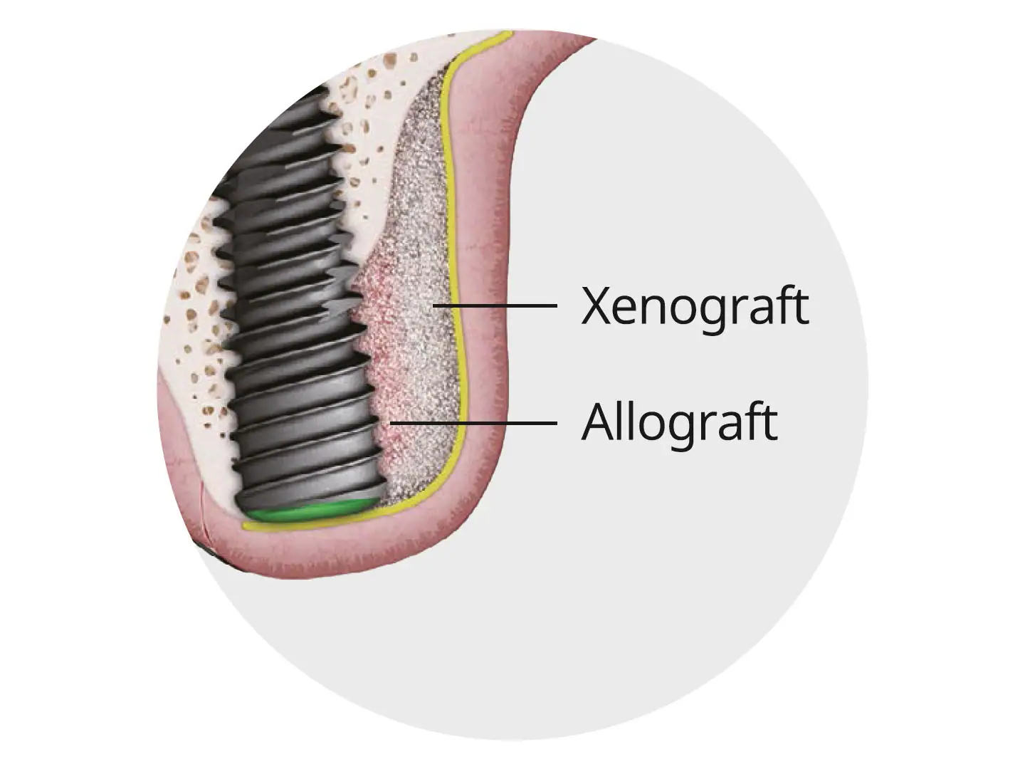 xenograft-allograft-a-oss